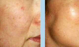 Биоармирование мезонитями Биоармирование мезонитями